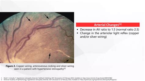 Hypertensive Retinopathy (2).pptx