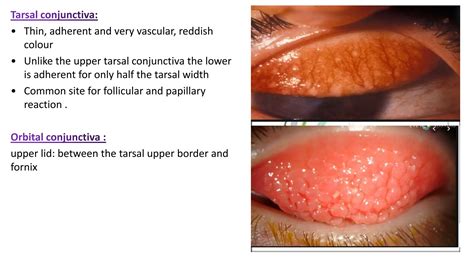 anatomy of conjunctiva. Ophthalmology slides | PPTX