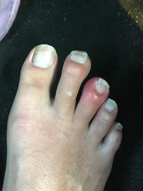 Middle toe looks inflamed? Not sure what's going on. : r/FootFunction