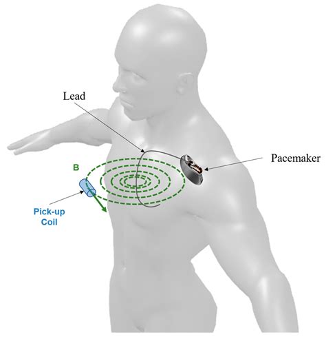 A Contactless Sensor for Pacemaker Pulse Detection: Design Hints and ...