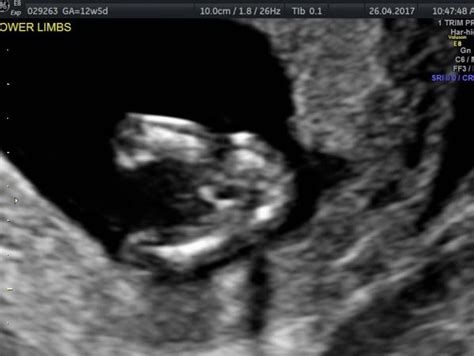 13 weeks pregnant : Gender prediction | BabyCenter