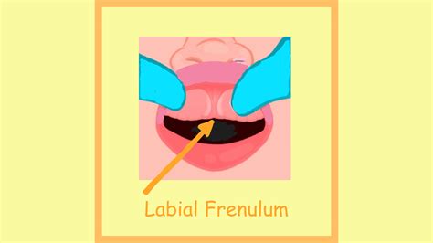 Tongue-Tie and Lip-Tie in Infants: A Compassionate, Evidence-Based ...