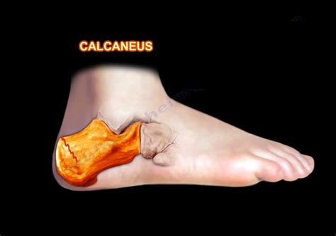 Stress Fractures of the Calcaneus — OrthopaedicPrinciples.com