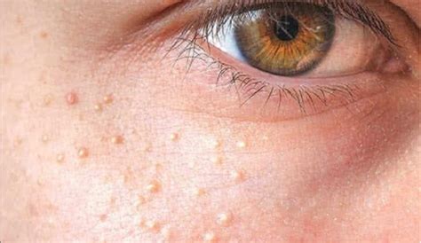 Effective home remedies to get rid milia or safed dane skin problem ...