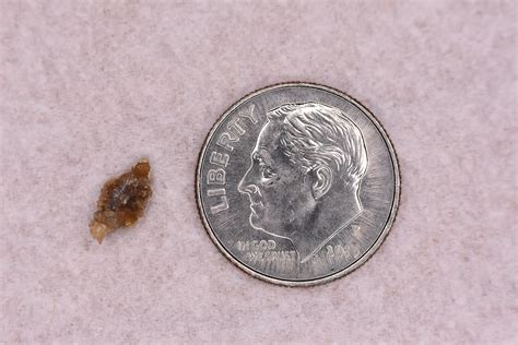 4.7x8.4mm kidney stone I passed. By far the worst physical pain I've ever felt. : r/Wellthatsucks