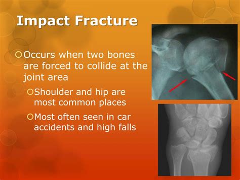 Impacted fracture - kidzmilo