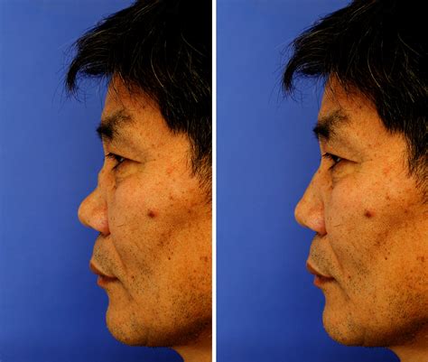 Saddle Nose Deformity Celebrities