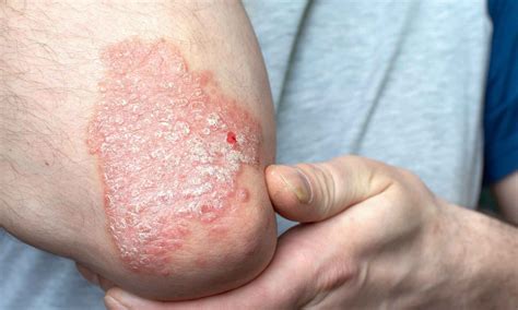 Spesolimab Shows Promise for Generalized Pustular Psoriasis: Study