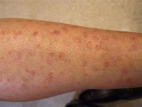 Disseminated superficial actinic porokeratosis | OnlineDermClinic.com | Spots on legs, Brown ...