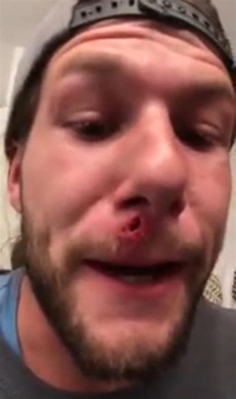Image result for Giant Abscess Exploding On Back