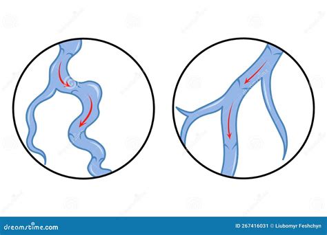 Varicose Veins. Blue Blood Vessel Visible through the Skin. Vascular Disease Diagnostic and ... - treat venous disease