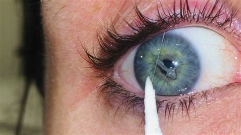 Eye mucous fishing syndrome - YouTube