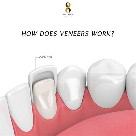 HOW DOES VENEERS WORK? - SMILE READY BALI