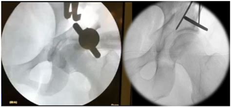 A New Rectus and Sartorius Sparing Approach for Periacetabular ...