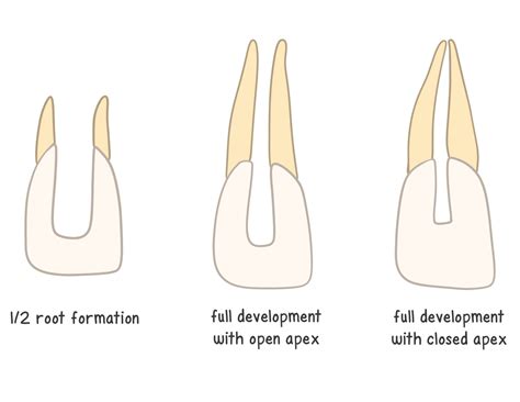 Pulpotomy vs. Pulpectomy - My Dental Key