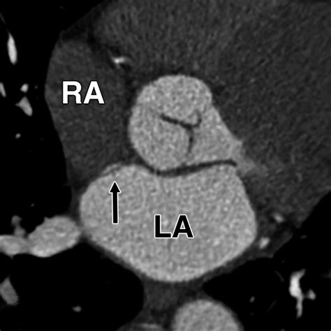 PFO Defect 的图像结果