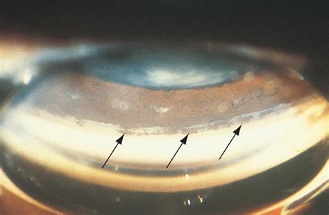 Angle Recession 的图像结果
