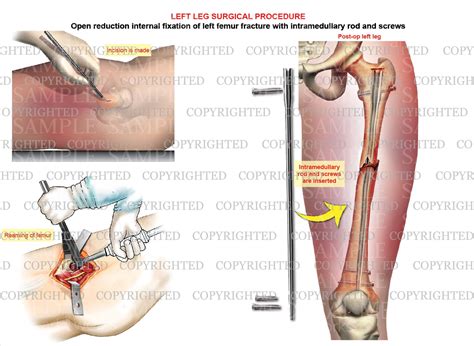 Define Open Reduction Internal Fixation