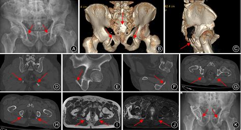 Ossification of Bilateral Sacrotuberous Ligaments: Two Cases Report and ...