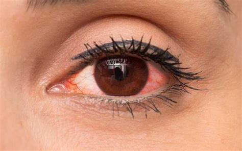 EYE DROPS FOR RED EYES IN INDIA – ozoneayurvedics