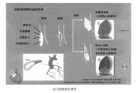 【图】急性冠脉综合征（ACS、急性心肌缺血综合征） - 心血管综合征学 - 天山医学院