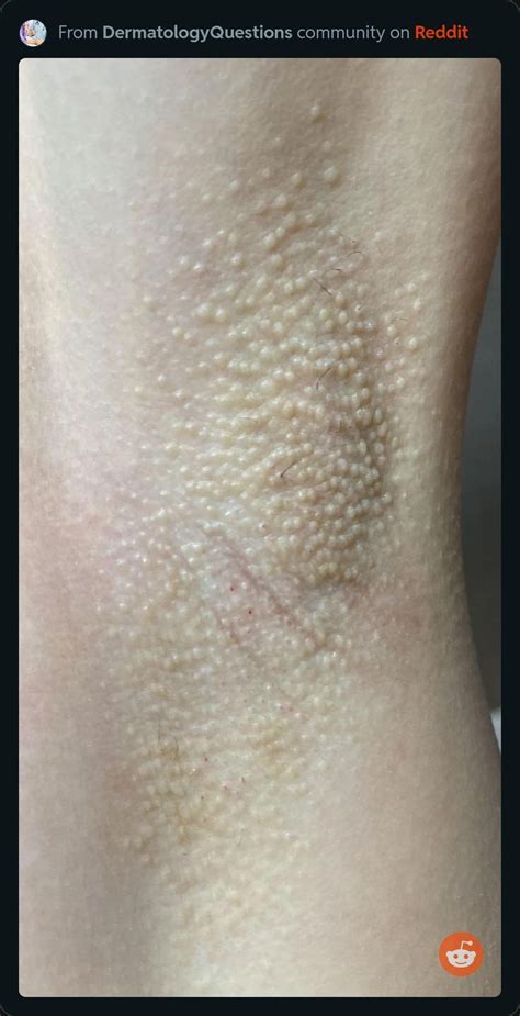 Lots of small bumps on armpit skin : r/Dermatology