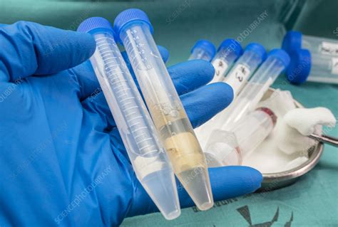 Image result for CSF Sample