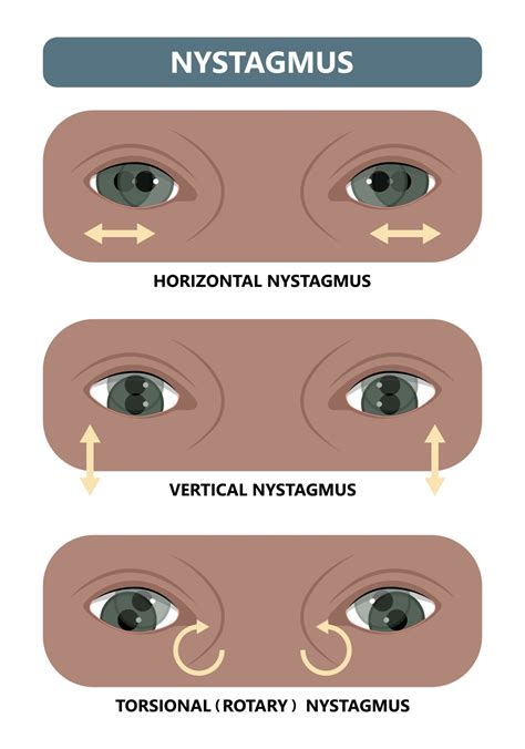 What Is Nystagmus? A Deep Dive Into This “Dancing Eye” Condition