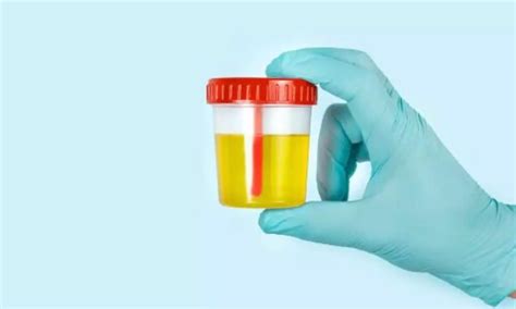 Urine Test May Detect Aggressive Prostate Cancer and Reduce Biopsies: Study