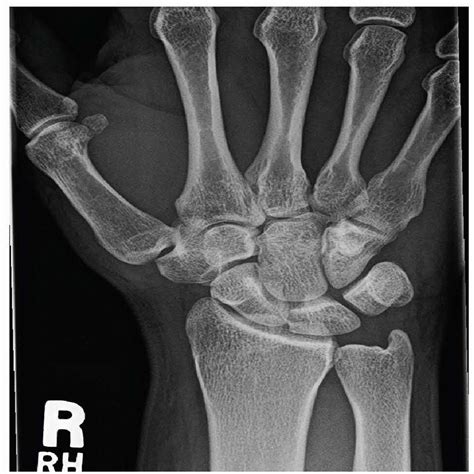 July Image Quiz; Fracture of the Hook of the Hamate : JBJS Journal of ...
