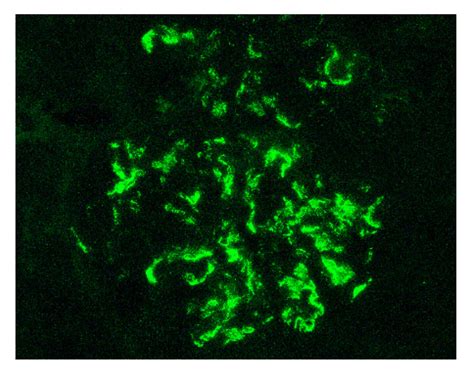 IgA Vasculitis and IgA Nephropathy: Same Disease?