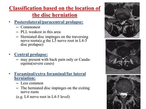 INTERVERTEBRAL DISC ANATOMY AND PIVD OF LUMBAR SPINE AND ITS MANAGEMENT ...