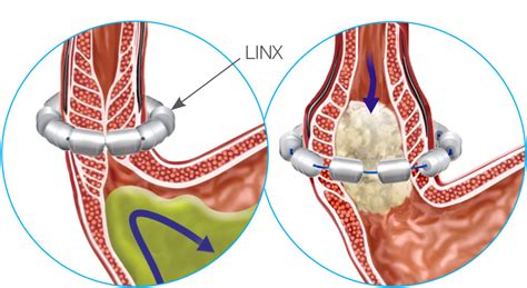 Image result for Linx Gerd Procedure
