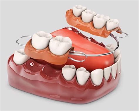 Dentures in Vijayawada | Best Denture Treatment in Vijayawada | Happy ...