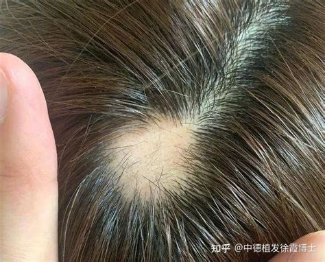 为何许多男性会遭遇斑秃问题_斑秃_北京京城皮肤医院(北京医保定点机构)