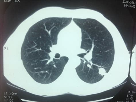 Image result for Poumon Normal Scanner