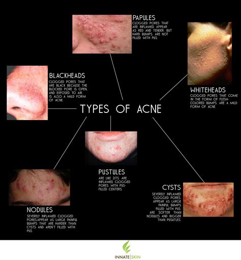 How to recognize what kind of acne you have – Artofit
