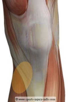 Kuvatulokset haulle pes anserine bursitis