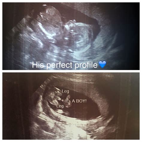 16 Week Ultrasound Boy