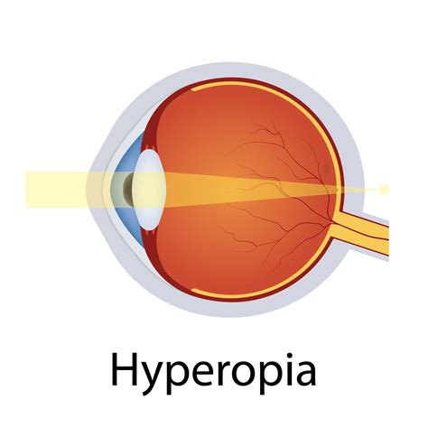 What is The Difference Between Myopia, Hyperopia, and Presbyopia? - New ...