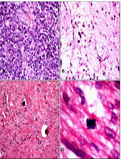 Clinicopathological and immunohistochemical study of gastrointestinal ...