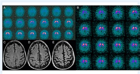Image result for Dat SPECT Scan