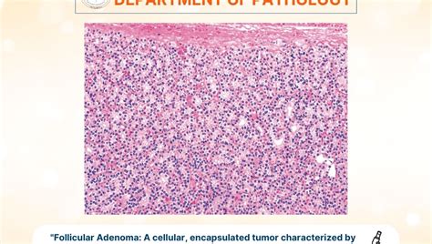 Adenoma of the Thyroid | bmch.edu.in