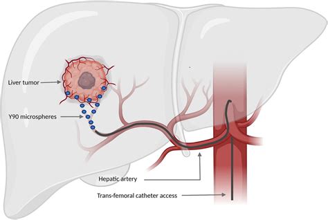 The role of immune checkpoint inhibitors and/or Yttrium-90 ...