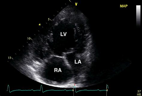 Exceptional survival: Double inlet left ventricle presenting with aortic dissection ...