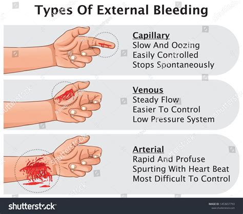 Types Of Bleeding