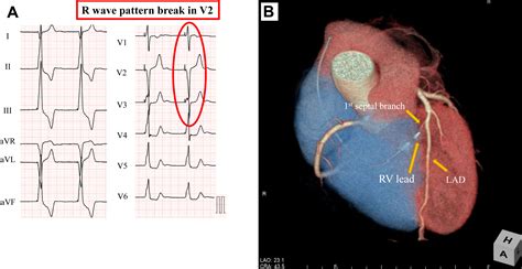 R-wave pattern break in lead V2 following permanent pacemaker ...