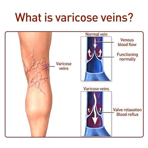 Varicose Veins Relief Cream Vasculitis Phlebitis | Ubuy India