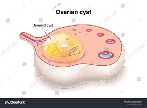 Dermoid Cyst Cross Section Vector Ovarian Stock Vector (Royalty Free) 2529241067 | Shutterstock