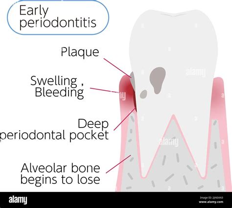 Illustration by stage of periodontal disease: early periodontitis Stock Vector Image & Art - Alamy